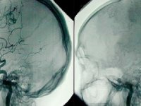 BEYİN ÖLÜMÜ SONRASI HASTANIN GERİ GELMESİ MÜMKÜN MÜDÜR?