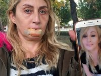 ESTETİK YAPTIRIRKEN DUDAĞINDAN OLDU